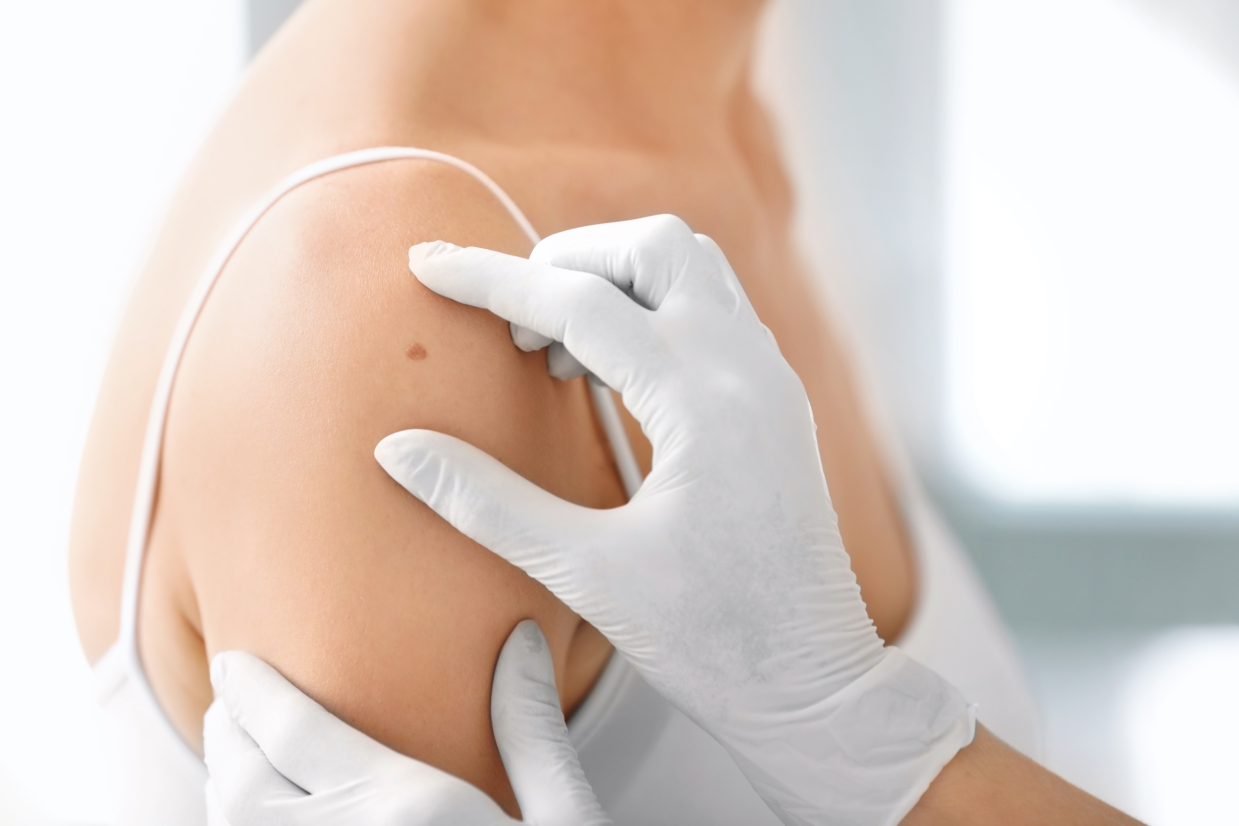 Dermatologist examining birthmark of patient, closeup. Cancer concept Dermatologist examining birthmark of patient, closeup. Cancer concept