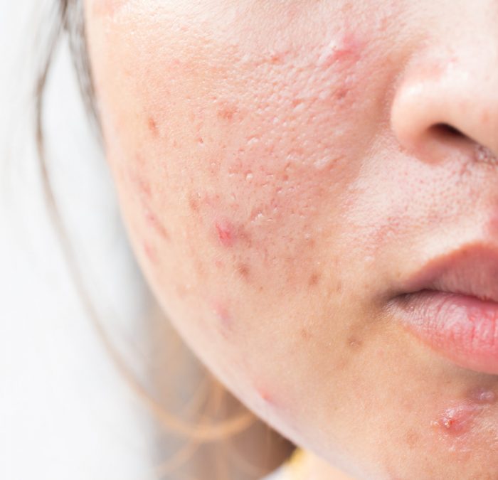 Girl with problematic skin and scars from acne (scar)