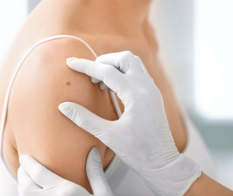 Dermatologist examining birthmark of patient, closeup. Cancer concept Dermatologist examining birthmark of patient, closeup. Cancer concept