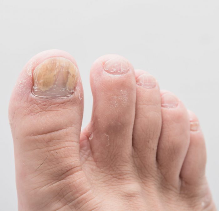 Close-up foot of nail fungus