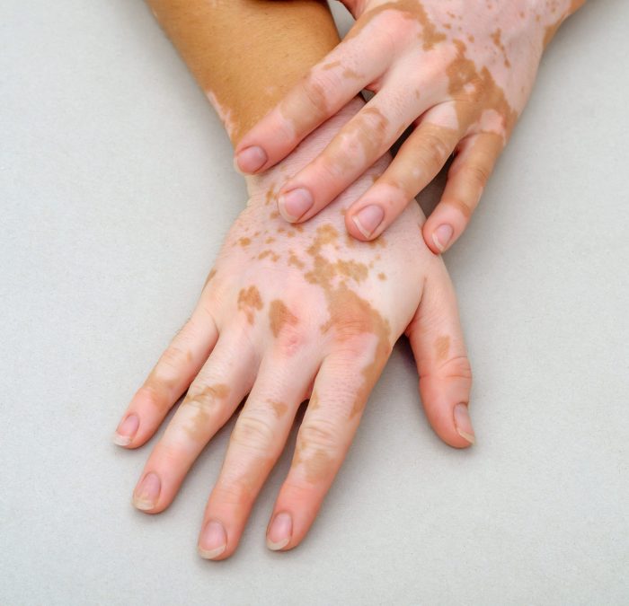Vitiligo on the skin of hands.
